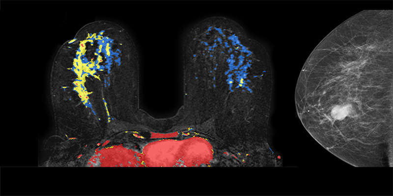 Breast Imaging Scans