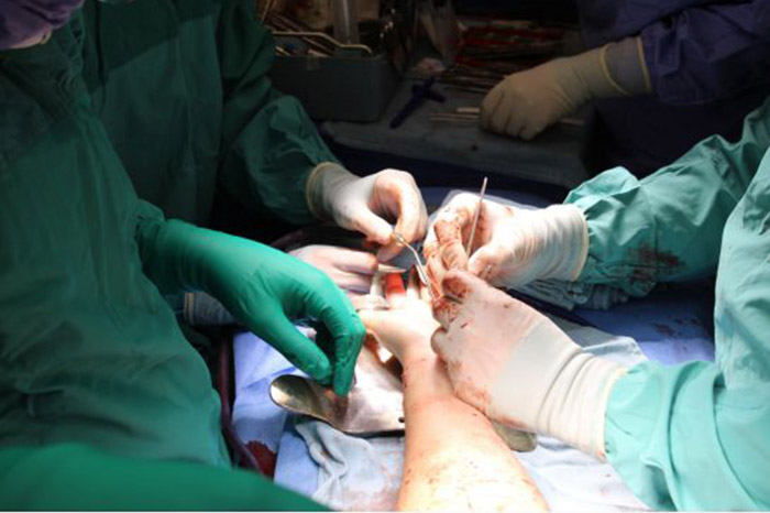 Photo of Hand Transplant Surgery