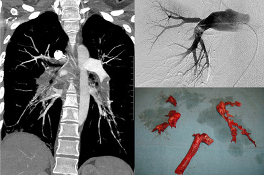 Acute Pulmonary Embolism